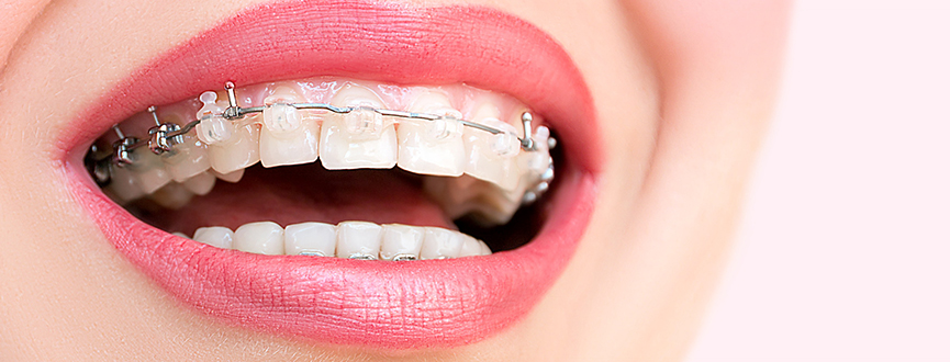 Ortodonzia Trasparente Centro Medico Odontoiatrico A.C.O. Dental